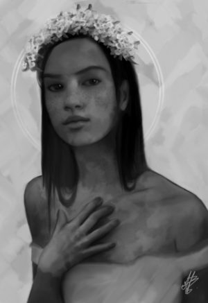 vitiligo
